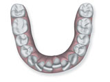 affollamento-dentale Affollamento dentale