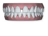 denti-spaziatura-eccessiva Denti con spaziatura eccessiva