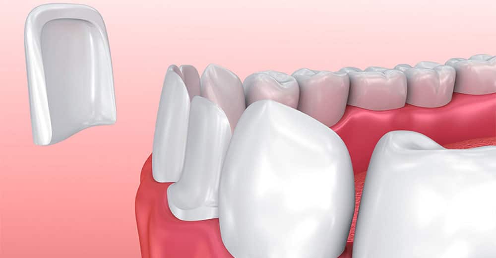 Odontoiatria estetica faccette dentali