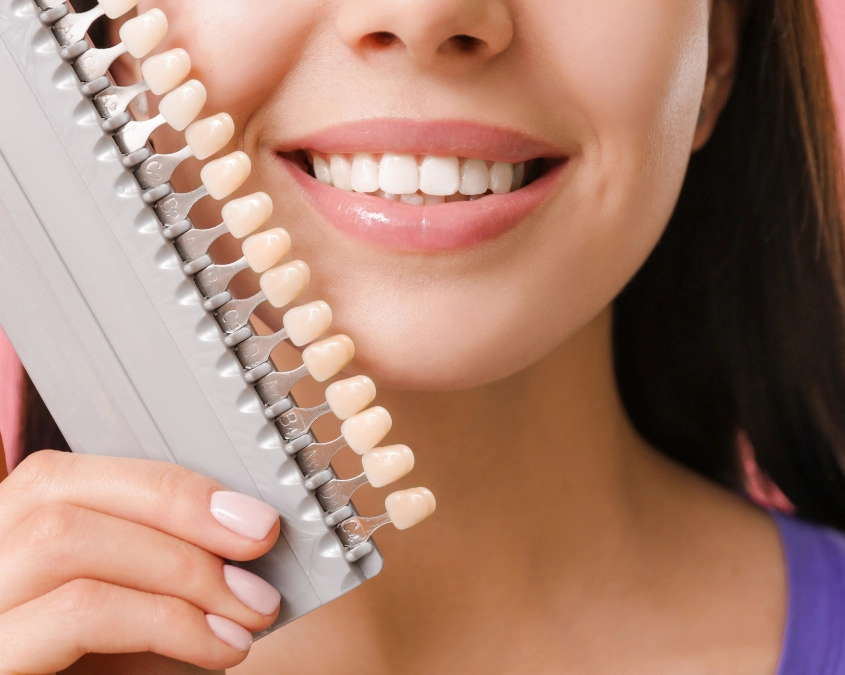 Faccette-dentali_-come-possono-migliorare-l’estetica-del-sorriso Faccette dentali, come possono migliorare l’estetica del sorriso?