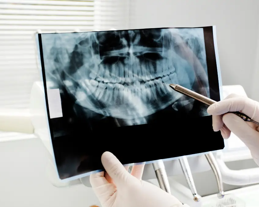 Agenesie dentali Agenesie dentali e ripercussioni ortodontiche